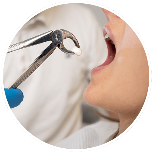 woman getting tooth extraction at Midway Dental Group 