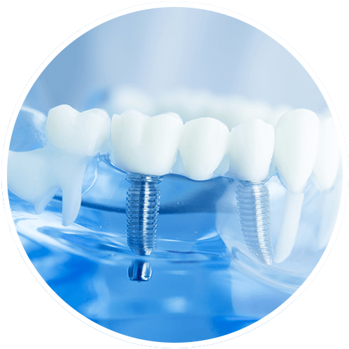 dental implants from midway dental group