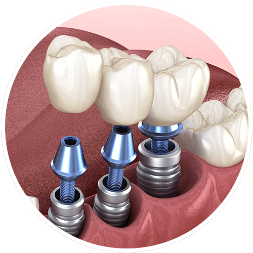 dental implant placement graphic of teeth