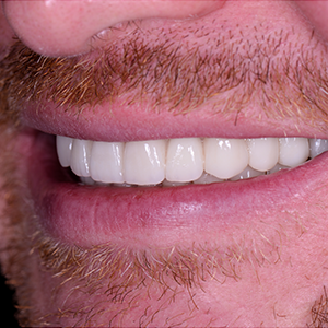 close up of healthy white teeth after restorative dental appointment at midway dental group