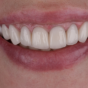 womans healthy white teeth after teeth whitening appointment at midway dental group