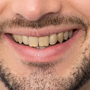 close up of yellow teeth before dental work at midway dental group