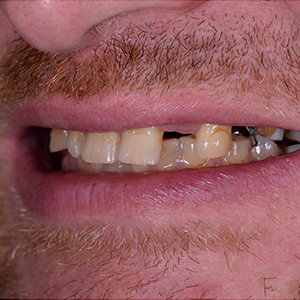 close up of yellow decaying teeth in el cajon california