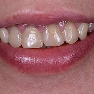 womans teeth with yellow spots and decayed mouth