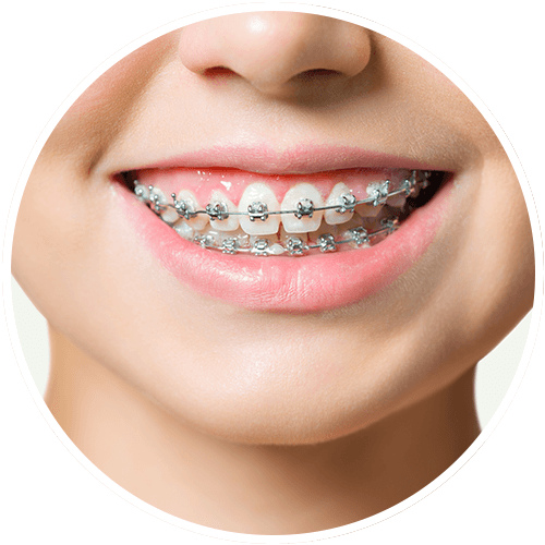 woman smiling with metallic braces from  midway dental group 