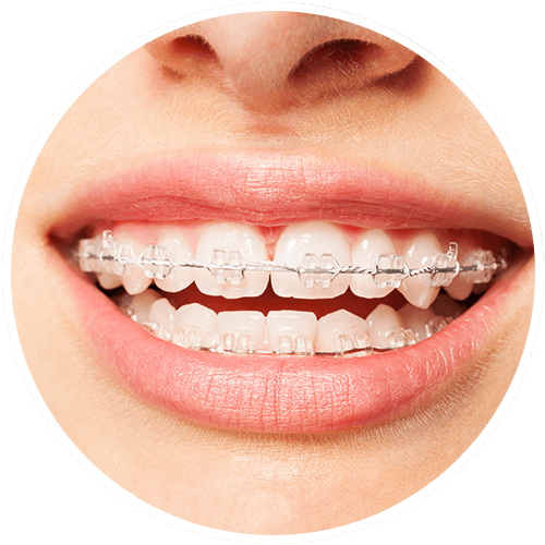 teenager smiling with ceramic braces from  midway dental group 